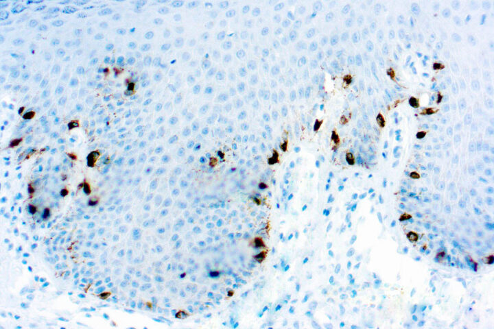 Immunohistochemical staining of Tyrosinase, Melanoma Marker  of human FFPE tissue followed by incubation with HRP labeled secondary and development with DAB substrate.