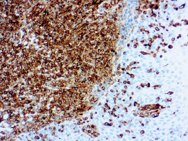 Immunohistochemical staining of Vimentin  of human FFPE tissue followed by incubation with HRP labeled secondary and development with DAB substrate.