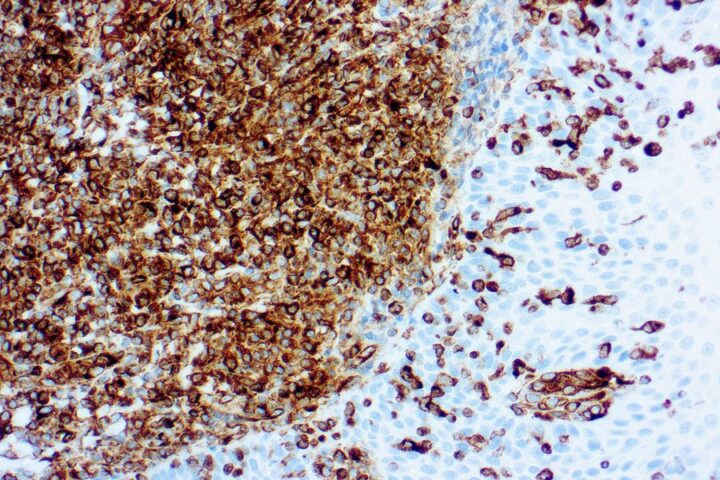 Immunohistochemical staining of Vimentin  of human FFPE tissue followed by incubation with HRP labeled secondary and development with DAB substrate.