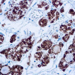 Immunohistochemical staining of Thyroid Peroxidase  of human FFPE tissue followed by incubation with HRP labeled secondary and development with DAB substrate.