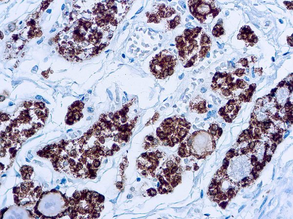 Immunohistochemical staining of Thyroid Peroxidase  of human FFPE tissue followed by incubation with HRP labeled secondary and development with DAB substrate.