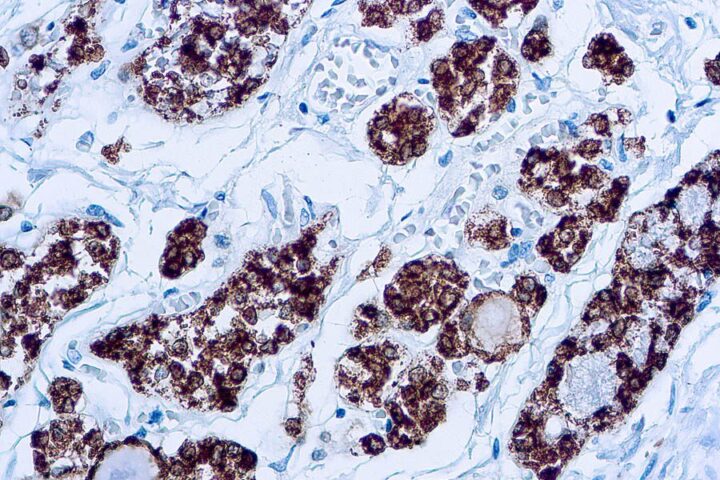 Immunohistochemical staining of Thyroid Peroxidase  of human FFPE tissue followed by incubation with HRP labeled secondary and development with DAB substrate.