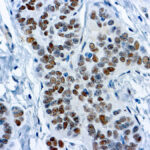 Immunohistochemical staining of Wilms Tumor 1 Protein ,  of human FFPE tissue followed by incubation with HRP labeled secondary and development with DAB substrate.