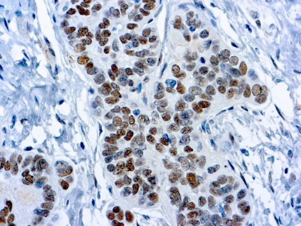Immunohistochemical staining of Wilms Tumor 1 Protein ,  of human FFPE tissue followed by incubation with HRP labeled secondary and development with DAB substrate.