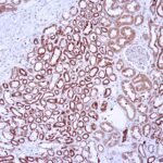 Immunohistochemical staining of Vascular Endothelial Growth Factor  of human FFPE tissue followed by incubation with HRP labeled secondary and development with DAB substrate.