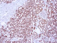 Immunohistochemical staining of Vascular Endothelial Growth Factor  of human FFPE tissue followed by incubation with HRP labeled secondary and development with DAB substrate.