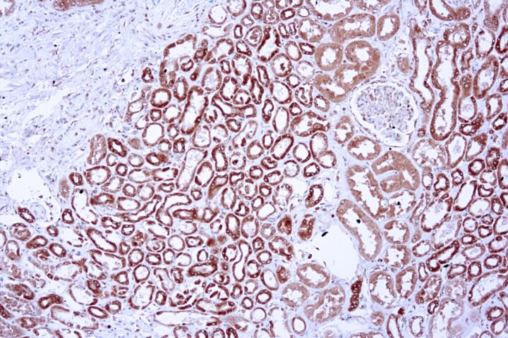 Immunohistochemical staining of Vascular Endothelial Growth Factor  of human FFPE tissue followed by incubation with HRP labeled secondary and development with DAB substrate.