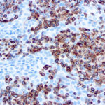 Immunohistochemical staining of Vimentin  of human FFPE tissue followed by incubation with HRP labeled secondary and development with DAB substrate.