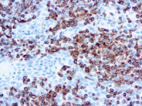 Immunohistochemical staining of Vimentin  of human FFPE tissue followed by incubation with HRP labeled secondary and development with DAB substrate.