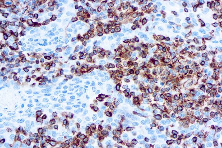 Immunohistochemical staining of Vimentin  of human FFPE tissue followed by incubation with HRP labeled secondary and development with DAB substrate.