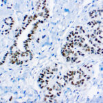 Immunohistochemical staining of Wilms Tumor 1 Protein  of human FFPE tissue followed by incubation with HRP labeled secondary and development with DAB substrate.