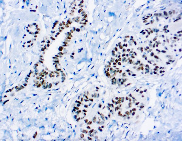 Immunohistochemical staining of Wilms Tumor 1 Protein  of human FFPE tissue followed by incubation with HRP labeled secondary and development with DAB substrate.
