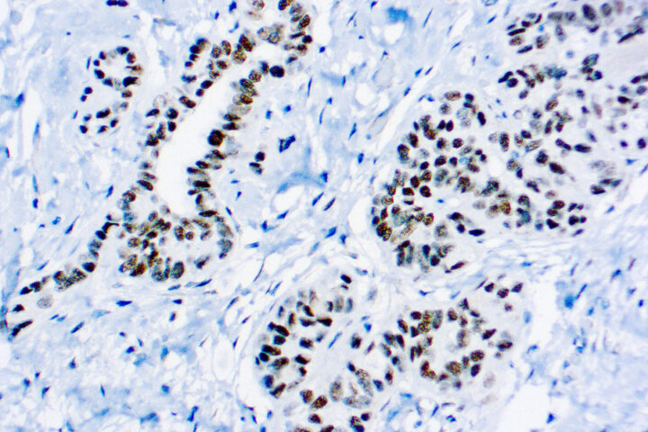 Immunohistochemical staining of Wilms Tumor 1 Protein  of human FFPE tissue followed by incubation with HRP labeled secondary and development with DAB substrate.