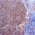 Immunohistochemical staining of alpha-1-Antitrypsin  of human FFPE tissue followed by incubation with HRP labeled secondary and development with DAB substrate.