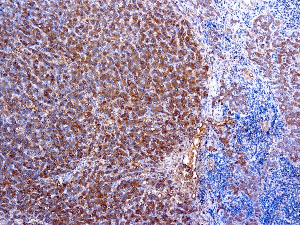 Immunohistochemical staining of alpha-1-Antitrypsin  of human FFPE tissue followed by incubation with HRP labeled secondary and development with DAB substrate.