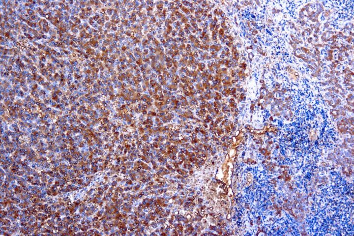 Immunohistochemical staining of alpha-1-Antitrypsin  of human FFPE tissue followed by incubation with HRP labeled secondary and development with DAB substrate.