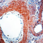 Immunohistochemical staining of beta-Amyloid Protein  of human FFPE tissue followed by incubation with HRP labeled secondary and development with DAB substrate.