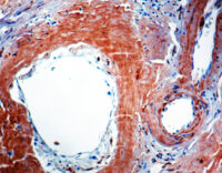 Immunohistochemical staining of beta-Amyloid Protein  of human FFPE tissue followed by incubation with HRP labeled secondary and development with DAB substrate.