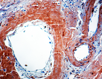 Immunohistochemical staining of beta-Amyloid Protein  of human FFPE tissue followed by incubation with HRP labeled secondary and development with DAB substrate.