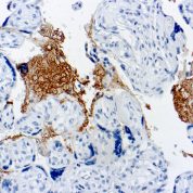 Immunohistochemical staining of Thrombospondin  of human FFPE tissue followed by incubation with HRP labeled secondary and development with DAB substrate.
