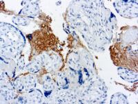 Immunohistochemical staining of Thrombospondin  of human FFPE tissue followed by incubation with HRP labeled secondary and development with DAB substrate.