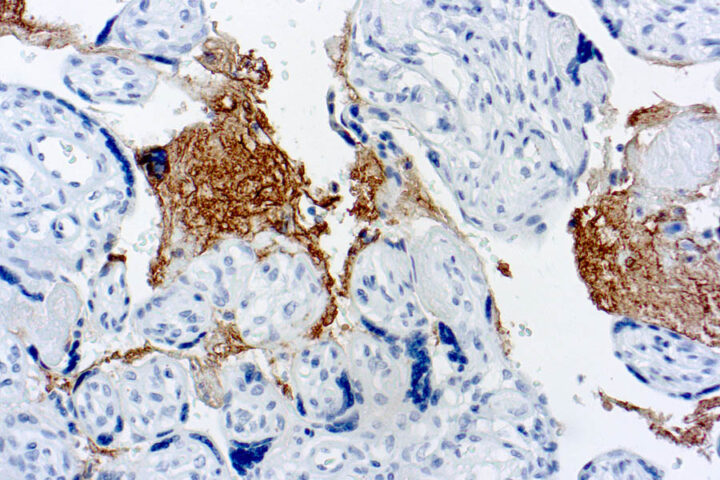 Immunohistochemical staining of Thrombospondin  of human FFPE tissue followed by incubation with HRP labeled secondary and development with DAB substrate.