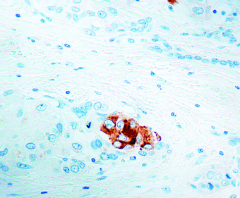 Immunohistochemical staining of alpha Fetoprotein  of human FFPE tissue followed by incubation with HRP labeled secondary and development with DAB substrate.