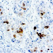 Immunohistochemical staining of alpha-1-Fetoprotein  of human FFPE tissue followed by incubation with HRP labeled secondary and development with DAB substrate.