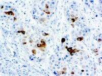 Immunohistochemical staining of alpha-1-Fetoprotein  of human FFPE tissue followed by incubation with HRP labeled secondary and development with DAB substrate.