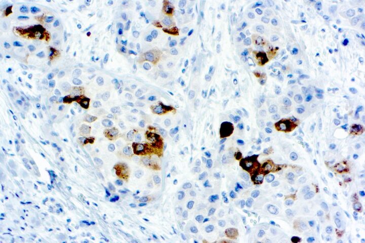 Immunohistochemical staining of alpha-1-Fetoprotein  of human FFPE tissue followed by incubation with HRP labeled secondary and development with DAB substrate.