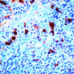 Immunohistochemical staining of alpha-1-Antichymotrypsin  of human FFPE tissue followed by incubation with HRP labeled secondary and development with DAB substrate.