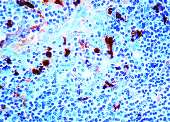 Immunohistochemical staining of alpha-1-Antichymotrypsin  of human FFPE tissue followed by incubation with HRP labeled secondary and development with DAB substrate.