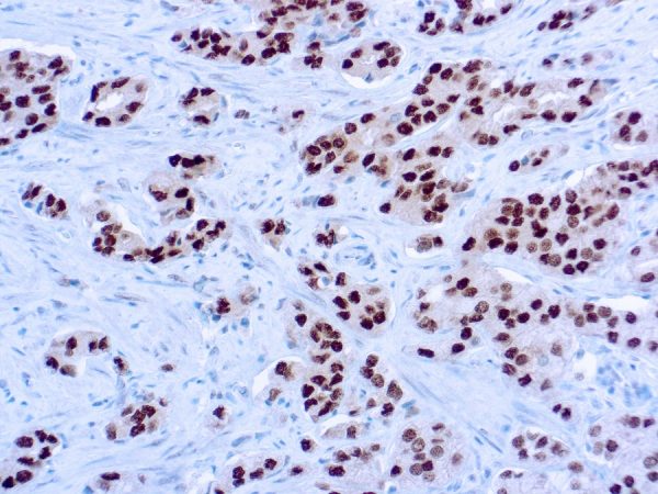 Immunohistochemical staining of Androgen Receptor  of human FFPE tissue followed by incubation with HRP labeled secondary and development with DAB substrate.
