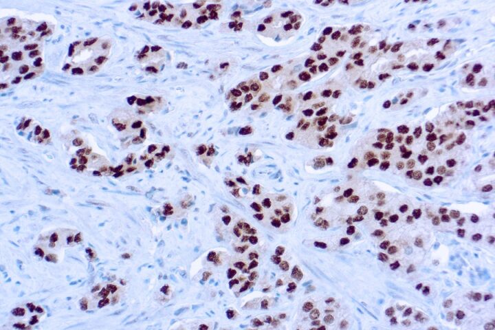 Immunohistochemical staining of Androgen Receptor  of human FFPE tissue followed by incubation with HRP labeled secondary and development with DAB substrate.