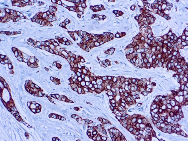 Immunohistochemical staining of CAM 5.2  of human FFPE tissue followed by incubation with HRP labeled secondary and development with DAB substrate.