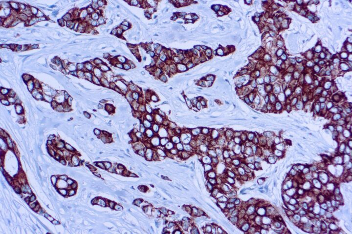 Immunohistochemical staining of CAM 5.2  of human FFPE tissue followed by incubation with HRP labeled secondary and development with DAB substrate.