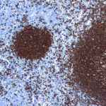 Immunohistochemical staining of CD20, B Cell  of human FFPE tissue followed by incubation with HRP labeled secondary and development with DAB substrate.