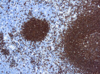 Immunohistochemical staining of CD20, B Cell  of human FFPE tissue followed by incubation with HRP labeled secondary and development with DAB substrate.