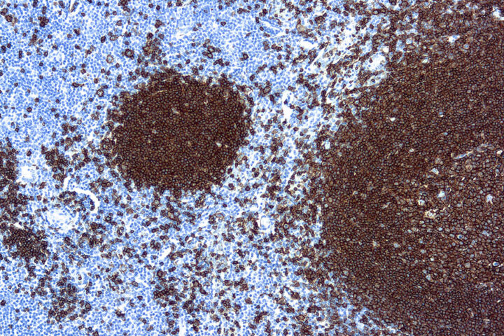 Immunohistochemical staining of CD20, B Cell  of human FFPE tissue followed by incubation with HRP labeled secondary and development with DAB substrate.