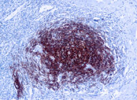 Immunohistochemical staining of CD21  of human FFPE tissue followed by incubation with HRP labeled secondary and development with DAB substrate.