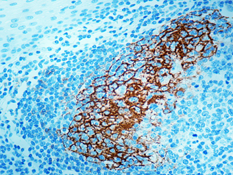 Immunohistochemical staining of CD23  of human FFPE tissue followed by incubation with HRP labeled secondary and development with DAB substrate.