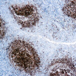 Immunohistochemical staining of CD23  of human FFPE tissue followed by incubation with HRP labeled secondary and development with DAB substrate.