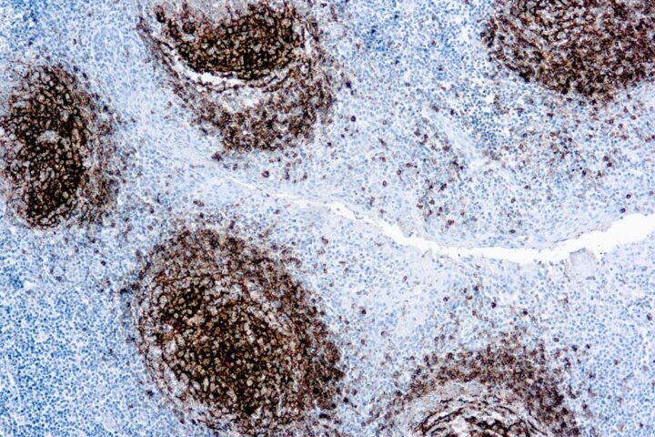 Immunohistochemical staining of CD23  of human FFPE tissue followed by incubation with HRP labeled secondary and development with DAB substrate.