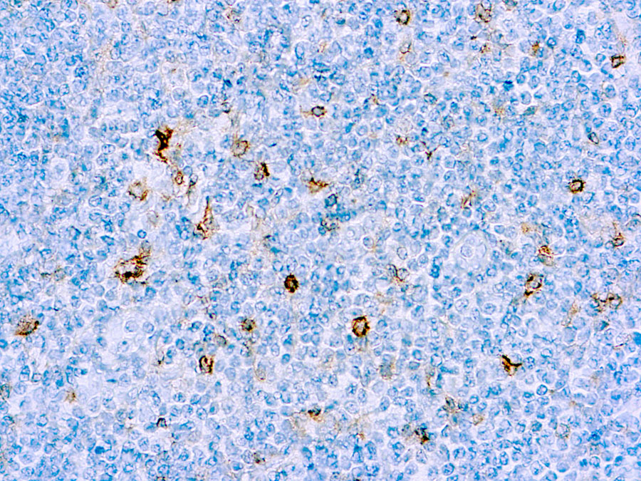 Immunohistochemical staining of CD25  of human FFPE tissue followed by incubation with HRP labeled secondary and development with DAB substrate.