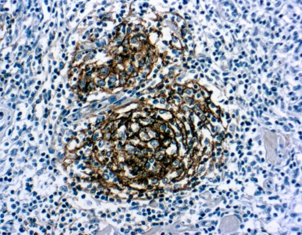 Immunohistochemical staining of CD21, B Cell  of human FFPE tissue followed by incubation with HRP labeled secondary and development with DAB substrate.