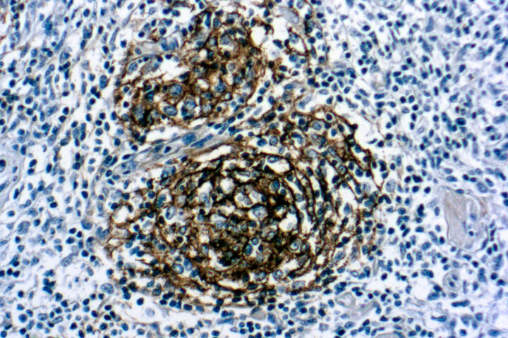 Immunohistochemical staining of CD21, B Cell  of human FFPE tissue followed by incubation with HRP labeled secondary and development with DAB substrate.