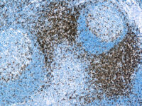 Immunohistochemical staining of CD3  of human FFPE tissue followed by incubation with HRP labeled secondary and development with DAB substrate.