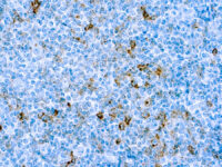 Immunohistochemical staining of CD25/IL-2R  of human FFPE tissue followed by incubation with HRP labeled secondary and development with DAB substrate.