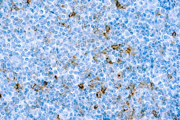 Immunohistochemical staining of CD25/IL-2R  of human FFPE tissue followed by incubation with HRP labeled secondary and development with DAB substrate.