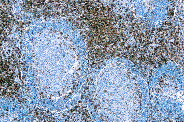 Immunohistochemical staining of CD3  of human FFPE tissue followed by incubation with HRP labeled secondary and development with DAB substrate.